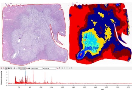 Tumeur hépatique, etude histologique et profil MALDI